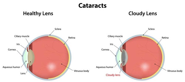 Cataracts - Best Cataract Surgeon in Indore