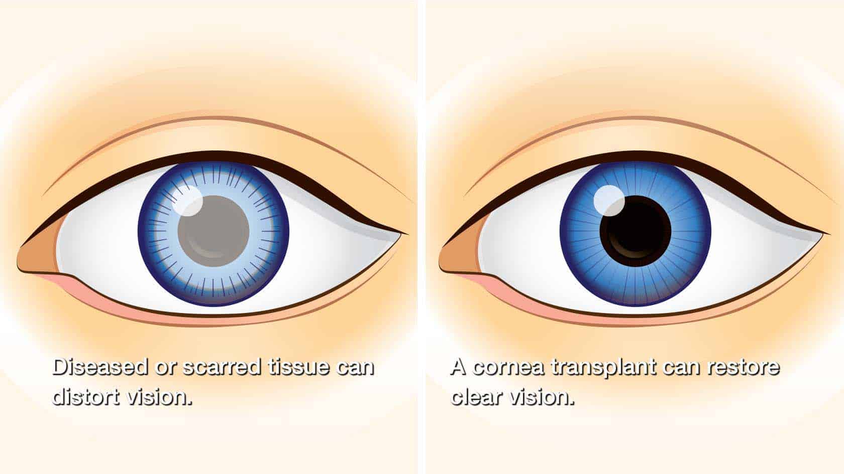 Corneal Transplant