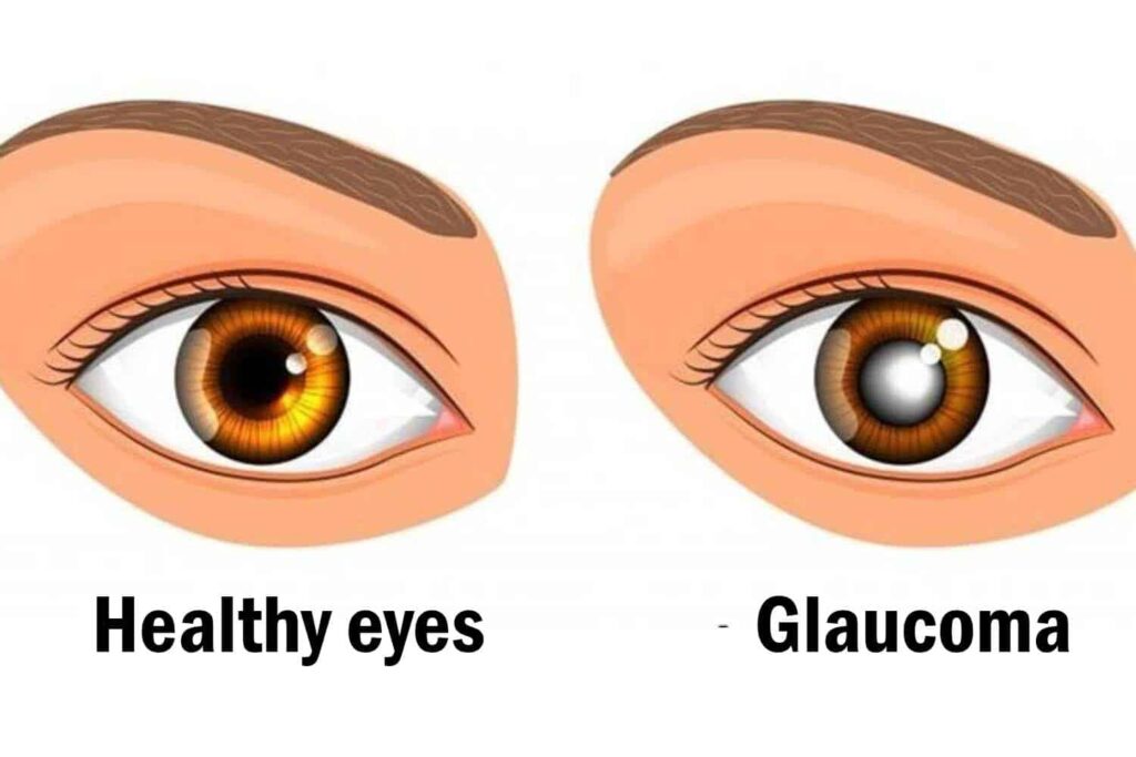 Best Glaucoma Surgeon and specialist near me