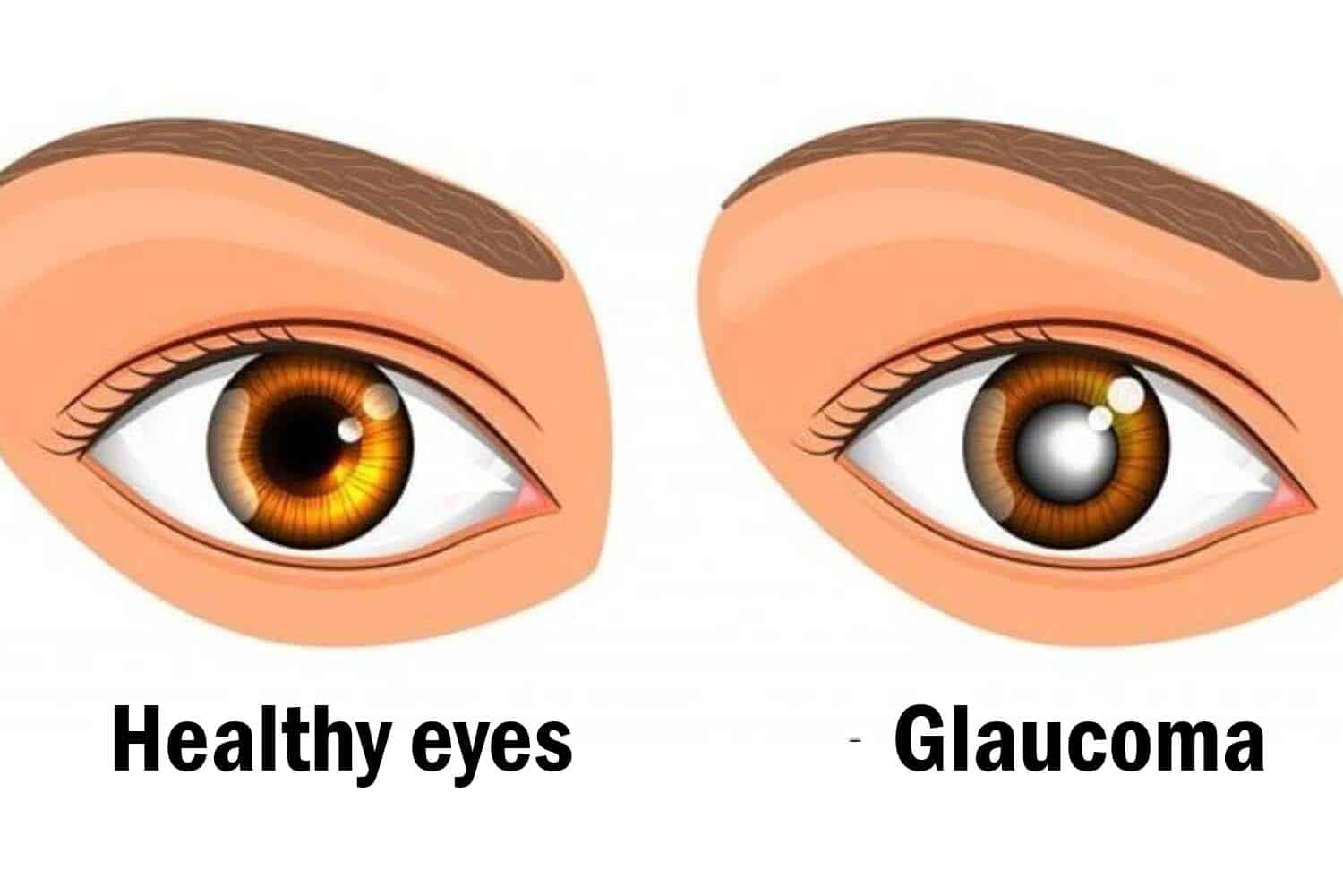 Glaucoma -